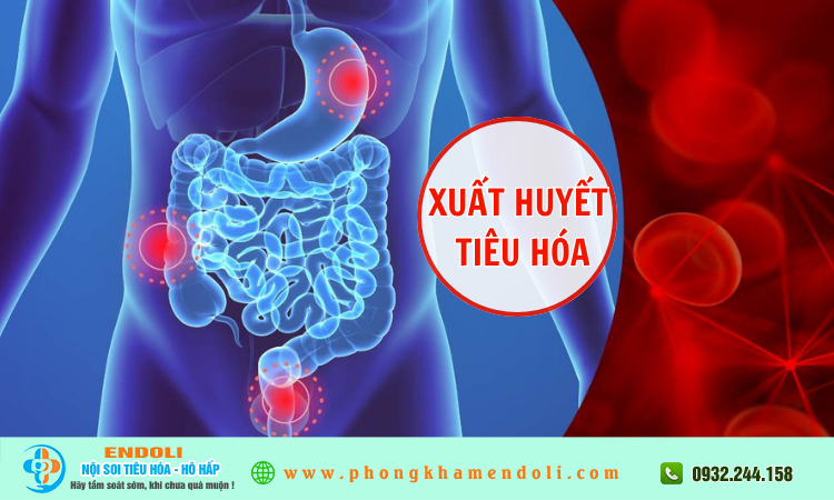 Bệnh xuất huyết tiêu hóa