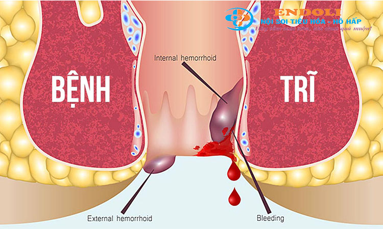 Bệnh trĩ 