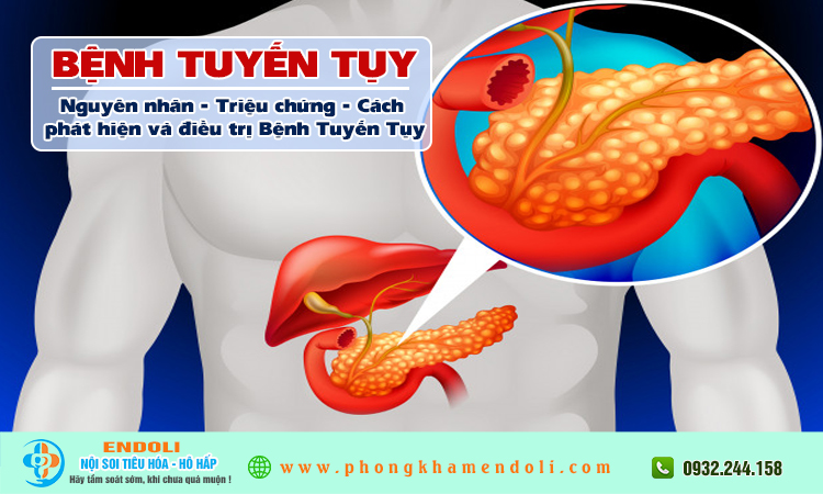 Bệnh ung thư tuyến tuỵ