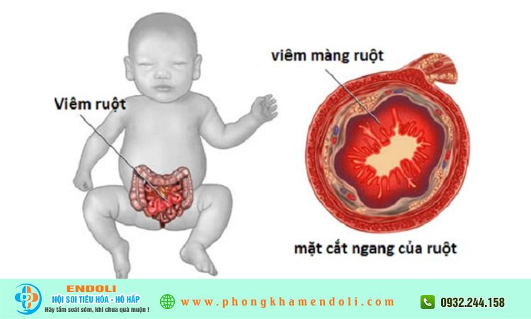 Bệnh về ruột và hấp thụ ở trẻ em