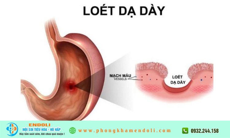 Biến chứng viêm loét dạ dày