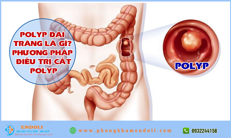 Cắt polyp đại tràng