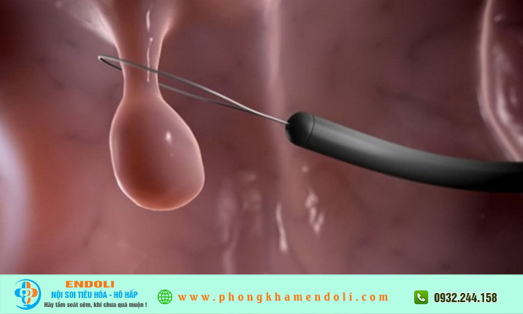 Cắt polyp thanh quản phải kiêng nói?