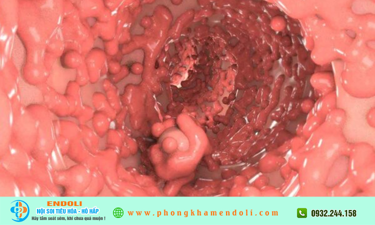 Đa polyp gia đình