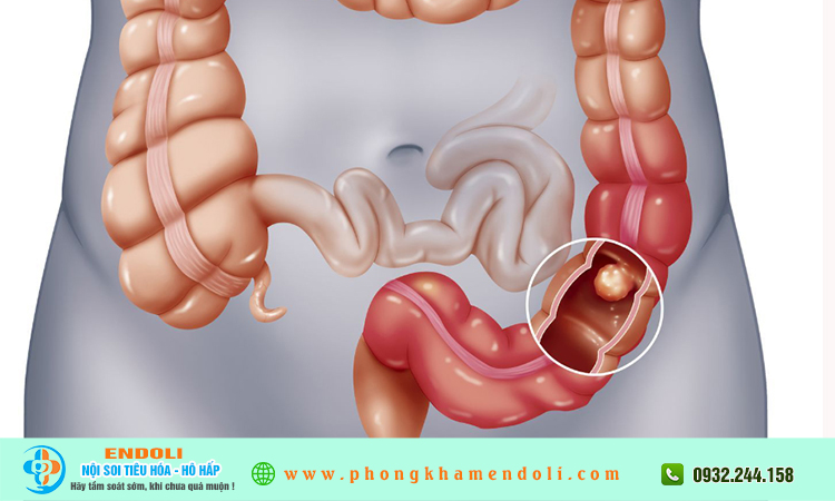 Đại tràng yếu là gì?