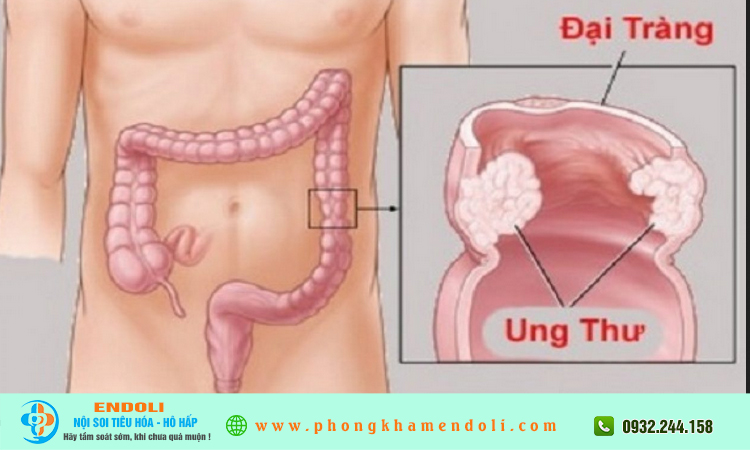 Dấu hiệu ung thư đại tràng giai đoạn 2