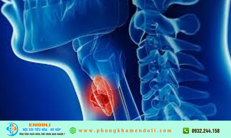 Dấu hiệu ung thư thanh quản