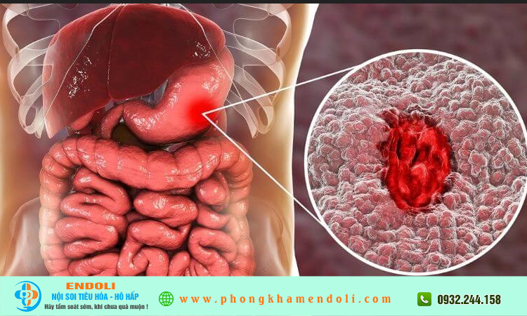 Đi ngoài ra máu có cần nội soi không?