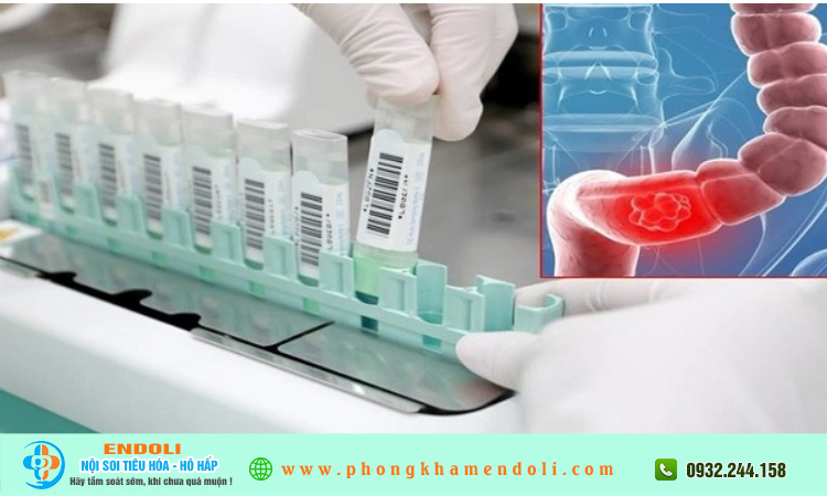 Những ai nên tầm soát ung thư đại trực tràng sớm?