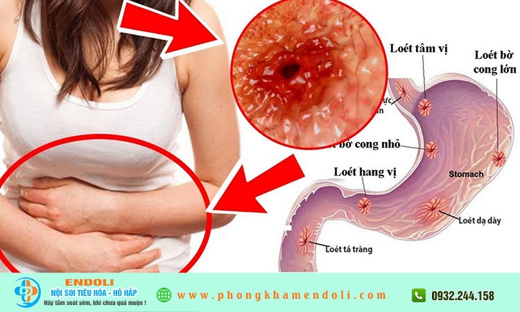 Phân biệt trào ngược và viêm dạ dày