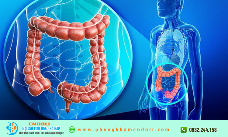  Polyp đại tràng 10mm có nguy hiểm không?