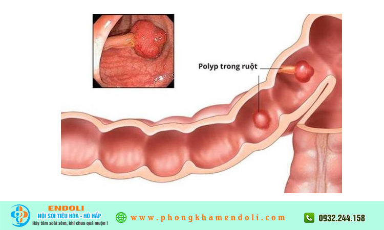 Polyp đại tràng 20mm có nguy hiểm không?