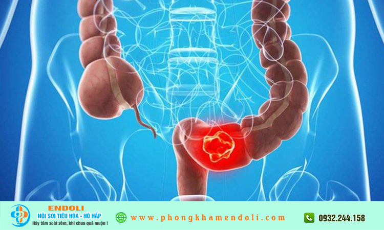Polyp đại tràng bao nhiêu mm thì phải cắt?