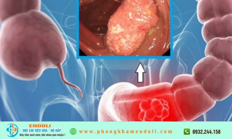 Polyp đại tràng có di truyền không?