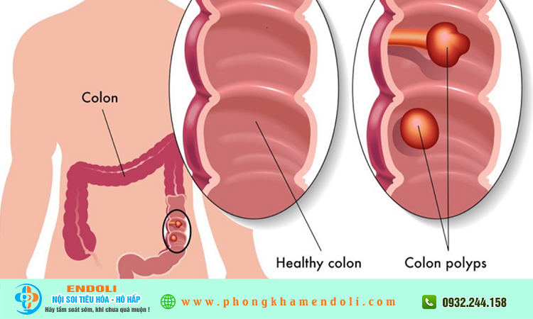 Polyp đại tràng ở người trẻ