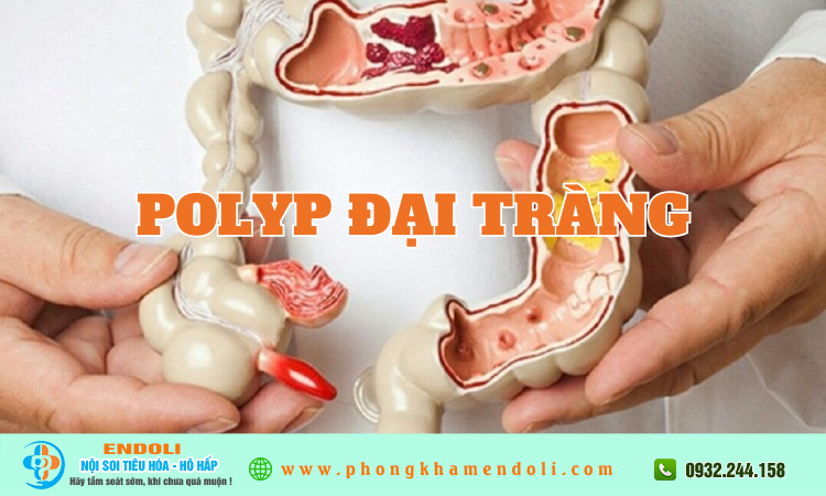 Polyp đại tràng có nguy hiểm không ?