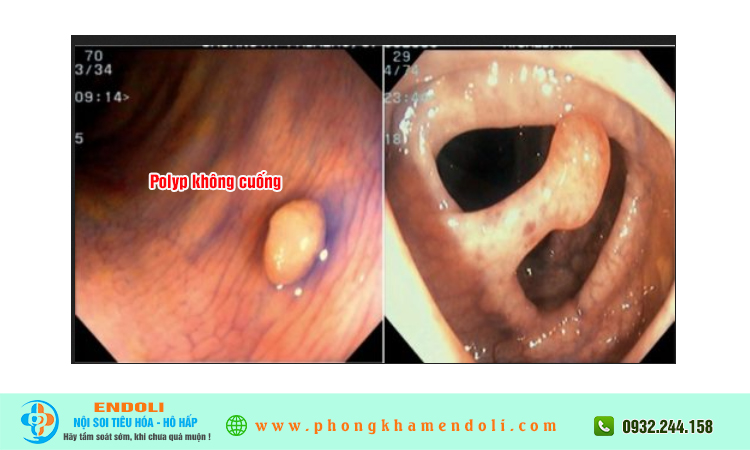 Polyp không cuống