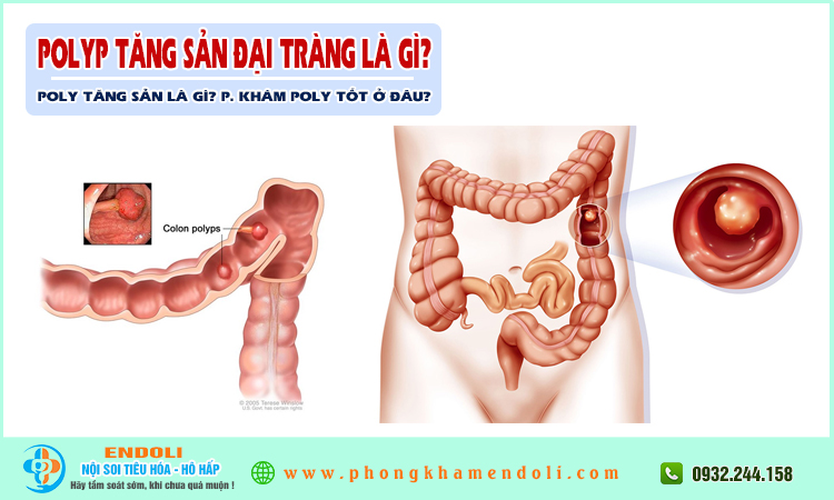 Polyp tăng sản đại tràng là gì?