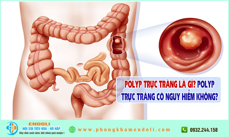 Polyp trực tràng