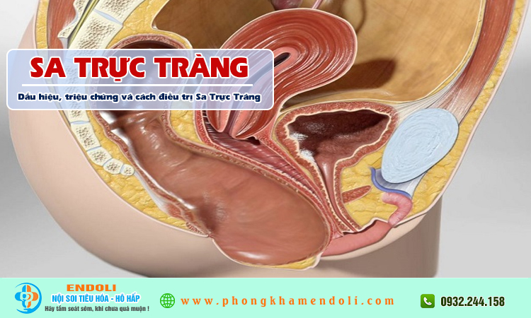 Sa trực tràng