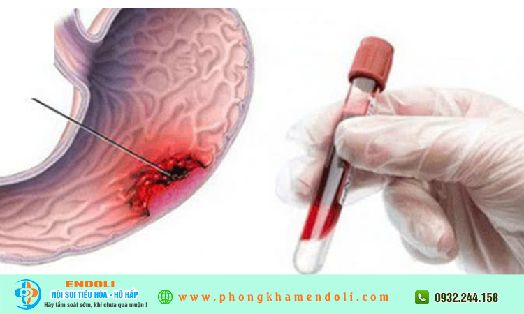 Sinh thiết dạ dày là gì? Có đau và nguy hiểm không?