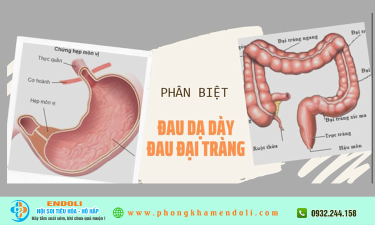 So sánh đau dạ dày và đau đại tràng