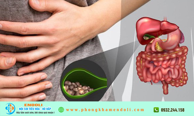 Sỏi mật có triệu chứng gì?