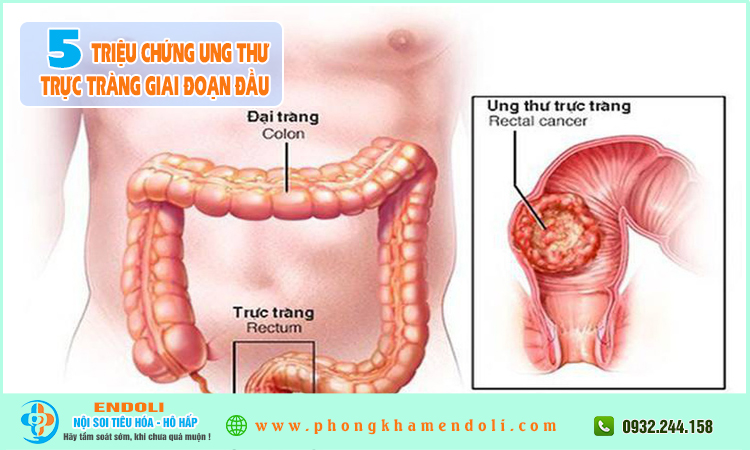 Triệu chứng ung thư trực tràng giai đoạn đầu