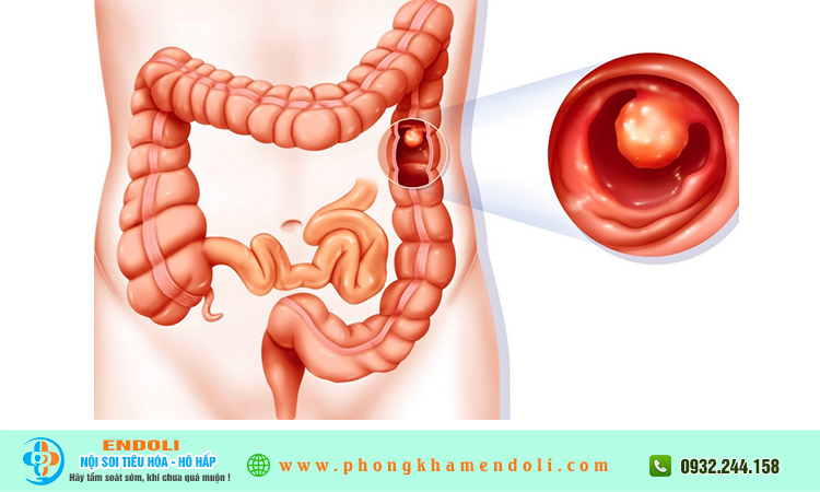U ác trực tràng sống được bao lâu