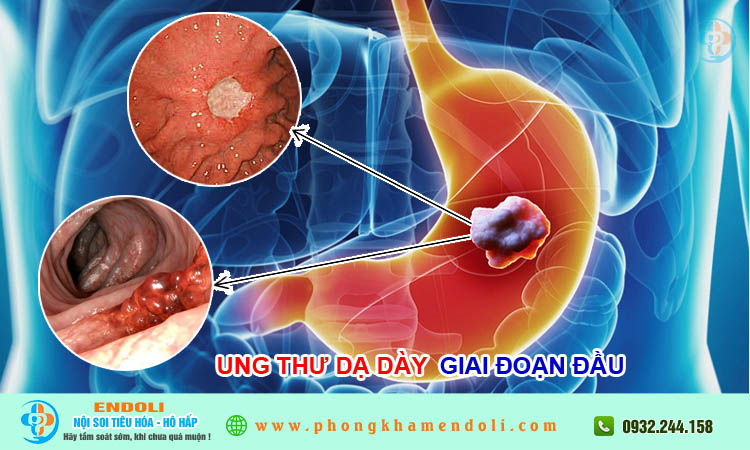 Ung thư dạ dày giai đoạn đầu