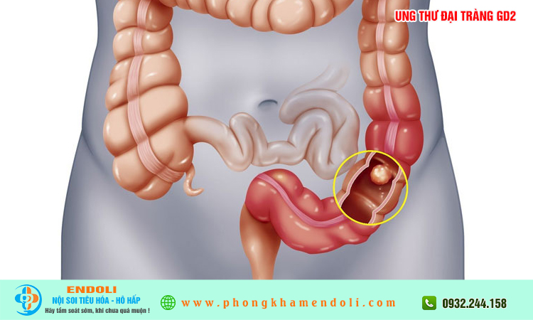 Ung thư đại tràng giai đoạn 2 sống được bao lâu