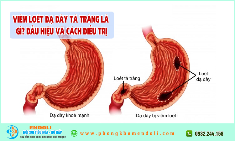 Viêm loét dạ dày tá tràng