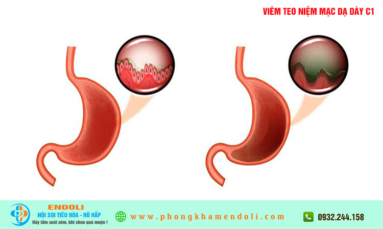 Viêm teo niêm mạc dạ dày c1 có chữa khỏi không