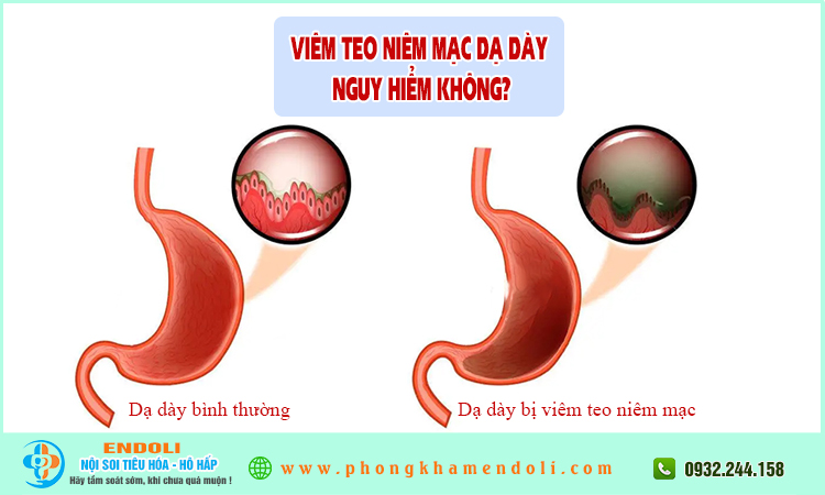 Viêm teo niêm mạc dạ dày