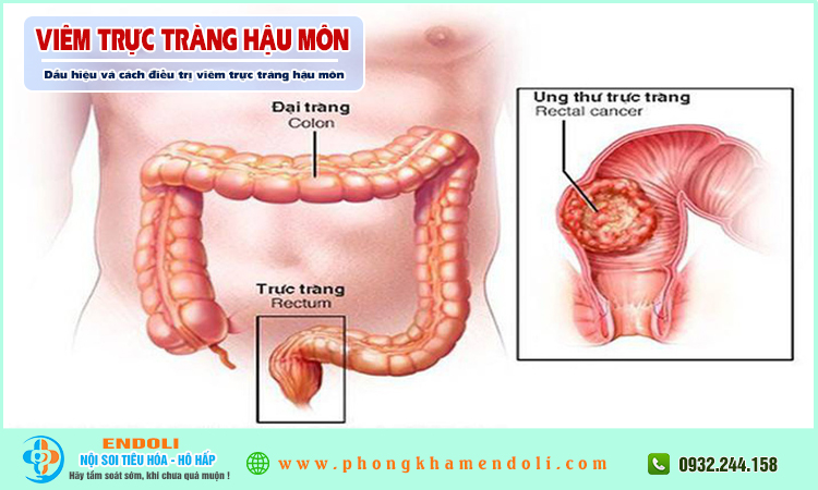 Viêm trực tràng hậu môn