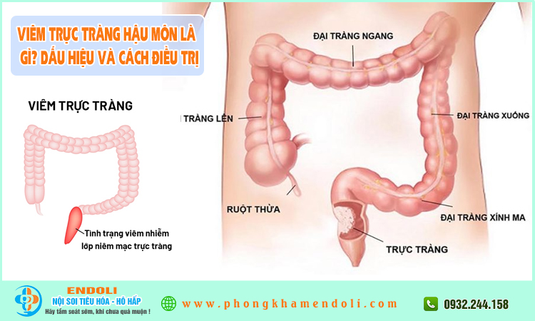 Viêm trực tràng hậu môn