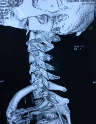 MRI trật C1C2 ra sau không kèm gãy mỏm răng sau chấn thương