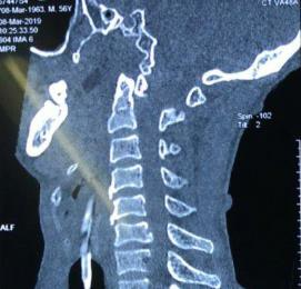 MRI trật C1C2 ra sau không kèm gãy mỏm răng sau chấn thương