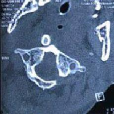 MRI trật C1C2 ra sau không kèm gãy mỏm răng sau chấn thương 3